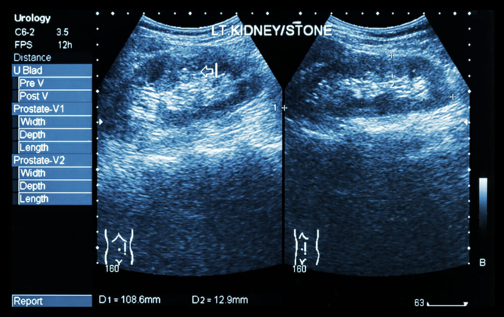 bilateral-renal-parenchymal-disease-ultrasound-picture