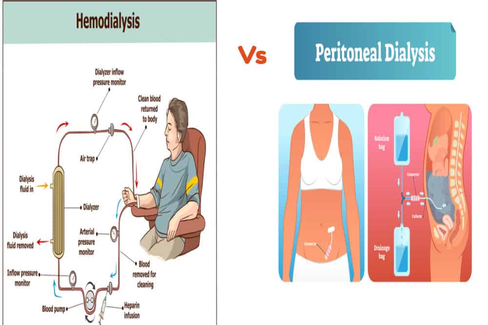 describe-the-difference-between-hemodialysis-and-peritoneal-dialysis