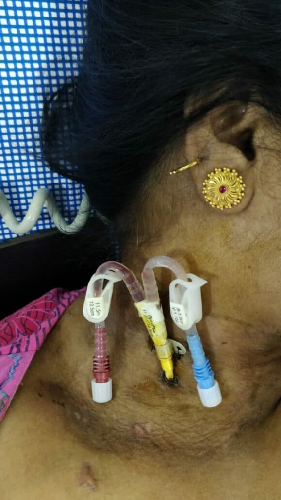 temporary catheter placed in the jugular vein in the neck